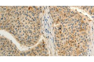 Immunohistochemistry of paraffin-embedded Human liver cancer tissue using FZD8 Polyclonal Antibody at dilution 1:50