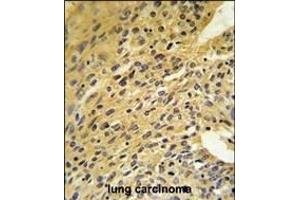 COQ5 Antibody (Center) (ABIN653267 and ABIN2842785) IHC analysis in formalin fixed and paraffin embedded human lung carcinoma followed by peroxidase conjugation of the secondary antibody and DAB staining. (COQ5 antibody  (AA 213-241))