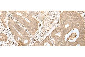 Immunohistochemistry of paraffin-embedded Human gastric cancer tissue using HDHD2 Polyclonal Antibody at dilution of 1:40(x200) (HDHD2 antibody)
