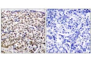 Immunohistochemical analysis of paraffin-embedded human breast carcinoma tissue using CREB (Ab-129) antibody (E021265). (CREB1 antibody)