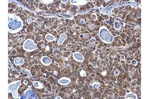 IHC-P Image SP1 antibody detects SP1 protein at nucleus on human gastric carcinoma by immunohistochemical analysis.