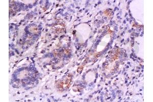 Formalin-fixed and paraffin embedded human thyroid carcinoma labeled with Anti-SKP2/skp2 p45 Polyclonal Antibody, Unconjugated (ABIN737601) at 1:200 followed by conjugation to the secondary antibody and DAB staining. (SKP2 antibody  (AA 351-424))