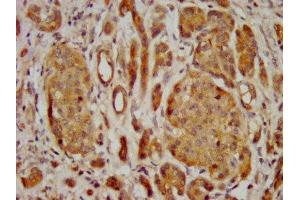 IHC image of ABIN7153155 diluted at 1:400 and staining in paraffin-embedded human pancreatic cancer performed on a Leica BondTM system. (FREM2 antibody  (AA 1986-2127))