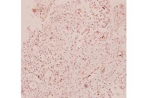 Immunohistochemistry analysis of RANTES Antibody in paraffin-embedded human breast carcinoma tissue at 1/100. (CCL5 antibody)