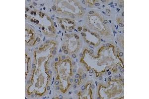 Immunohistochemistry of paraffin-embedded human kidney cancer using TNFRSF6B antibody at dilution of 1:200 (400x lens). (TNFRSF6B antibody)