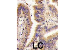 Formalin-fixed and paraffin-embedded human lung carcinoma tissue reacted with TGM2 polyclonal antibody  , which was peroxidase-conjugated to the secondary antibody, followed by DAB staining. (Transglutaminase 2 antibody  (Internal Region))