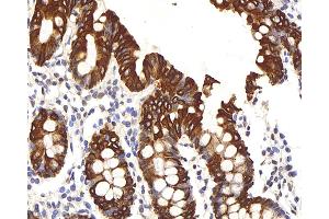 Immunohistochemistry analysis of paraffin-embedded human colon using CK-8 Polyclonal Antibody at dilution of 1:200. (KRT8 antibody)