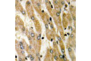 Immunohistochemical analysis of ACSL6 staining in human liver cancer formalin fixed paraffin embedded tissue section. (ACSL6 antibody  (Center))