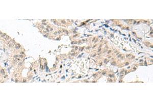Immunohistochemistry of paraffin-embedded Human thyroid cancer tissue using GFI1B Polyclonal Antibody at dilution of 1:80(x200)