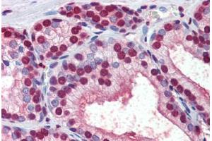 Human Prostate (formalin-fixed, paraffin-embedded) stained with  antibody ABIN462276 followed by biotinylated secondary antibody, alkaline phosphatase-streptavidin and chromogen. (CRABP1 antibody  (AA 1-137))