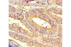 Immunohistochemistry of paraffin-embedded human endometrial cancer using ABIN7149400 at dilution of 1:100 (CNDP2 antibody  (AA 2-475))