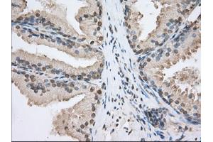 Immunohistochemical staining of paraffin-embedded Adenocarcinoma of Human ovary tissue using anti-SNX9 mouse monoclonal antibody. (SNX9 antibody)