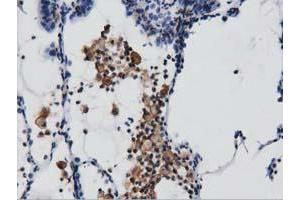 Immunohistochemical staining of paraffin-embedded Carcinoma of Human lung tissue using anti-ARHGAP25 mouse monoclonal antibody.