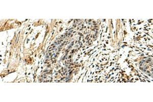 Immunohistochemistry of paraffin-embedded Human esophagus cancer tissue using NUTF2 Polyclonal Antibody at dilution of 1:110(x200)