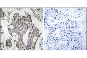 Immunohistochemistry analysis of paraffin-embedded human breast carcinoma tissue, using RAB3GAP2 Antibody. (RAB3GAP2 antibody  (AA 417-466))