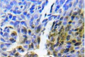 Immunohistochemistry (IHC) analyzes of Abl1 antibody in paraffin-embedded human lung adenocarcinoma tissue. (ABL1 antibody)