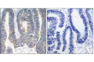 Immunohistochemical analysis of paraffin-embedded human colon carcinoma tissue using PKR (Ab-451) antibody (E021282). (EIF2AK2 antibody)