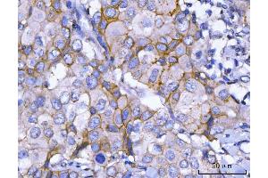 IHC analysis of HER2/ERBB2 using anti-HER2/ERBB2 antibody (ABIN7602717). (ErbB2/Her2 antibody  (AA 980-1230))