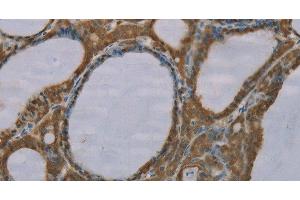 Immunohistochemistry of paraffin-embedded Human thyroid cancer tissue using S100A6 Polyclonal Antibody at dilution 1:35 (S100A6 antibody)