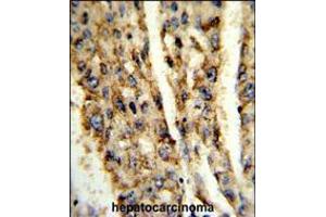 Formalin-fixed and paraffin-embedded human hepatocarcinoma reacted with DIO3 Antibody , which was peroxidase-conjugated to the secondary antibody, followed by DAB staining. (DIO3 antibody  (C-Term))