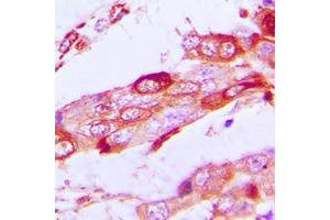 Immunohistochemical analysis of SSBP1 staining in human lung cancer formalin fixed paraffin embedded tissue section. (SSBP1 antibody  (C-Term))