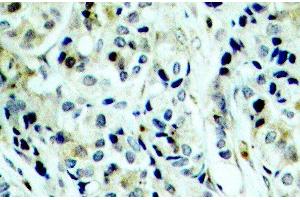 Immunohistochemistry of paraffin-embedded Human breast carcinoma using Phospho-HDAC5(S498) Polyclonal Antibody (HDAC5 antibody  (pSer498))