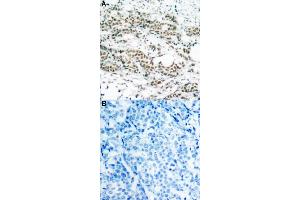 Immunohistochemical staining of human breast cancer tissue by FOXO4 (phospho S197) polyclonal antibody  without blocking peptide (A) or preincubated with blocking peptide (B) under 1:50-1:100 dilution. (FOXO4 antibody  (pSer197))