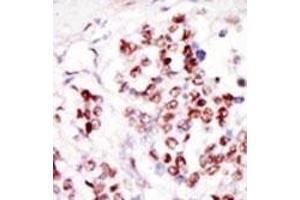 Formalin-fixed and paraffin-embedded human cancer tissue reacted with the primary antibody, which was peroxidase-conjugated to the secondary antibody, followed by DAB staining. (TLK1 antibody  (C-Term))
