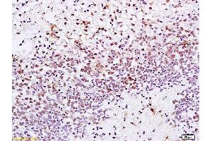 Formalin-fixed and paraffin embedded human gastric carcinoma labeled with Anti-XRCC1 Polyclonal Antibody, Unconjugated (ABIN673539) at 1:200 followed by conjugation to the secondary antibody and DAB staining. (XRCC1 antibody  (AA 1-120))