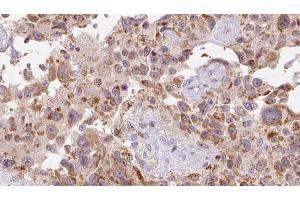 ABIN6273118 at 1/100 staining Human Melanoma tissue by IHC-P. (FSTL1 antibody  (N-Term))