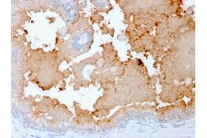 Formalin-fixed, paraffin-embedded human Prostate Carcinoma stained with AMACR Recombinant Mouse Monoclonal Antibody (rAMACR/1864). (Recombinant AMACR antibody  (AA 297-394))