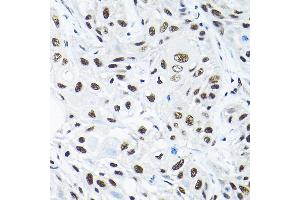 Immunohistochemistry of paraffin-embedded human esophageal cancer using SNRP Rabbit pAb (2161) at dilution of 1:200 (40x lens). (SNRPA1 antibody  (AA 1-220))