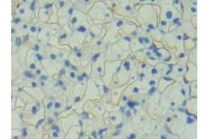 Detection of PODXL in Human Renal cancer Tissue using Polyclonal Antibody to Podocalyxin (PODXL) (PODXL antibody  (AA 220-431))