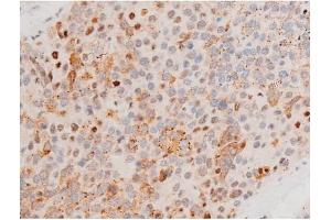 ABIN6267525 at 1/200 staining Human liver cancer tissue sections by IHC-P. (GATA4 antibody  (pSer262))