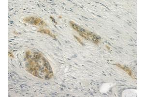 ABIN6266372 and ABIN6277338 at 1/100 staining human pancreatic carcinoma by IHC-P. (CDH23 antibody  (N-Term))