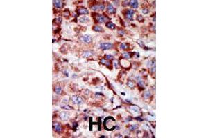 Formalin-fixed and paraffin-embedded human hepatocellular carcinoma tissue reacted with AK2 polyclonal antibody  , which was peroxidase-conjugated to the secondary antibody, followed by AEC staining. (Adenylate Kinase 2 antibody  (C-Term))