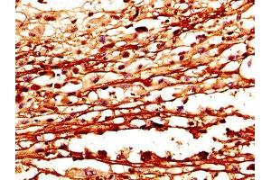 IHC image of ABIN7148983 diluted at 1:400 and staining in paraffin-embedded human melanoma performed on a Leica BondTM system. (CSTA antibody  (AA 2-98))