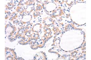 The image on the left is immunohistochemistry of paraffin-embedded Human thyroid cancer tissue using ABIN7131495(TRPC7 Antibody) at dilution 1/25, on the right is treated with fusion protein. (TRPC7 antibody)