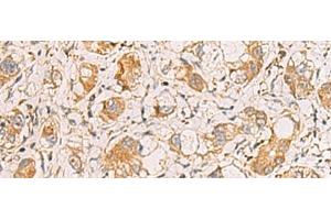 Immunohistochemistry of paraffin-embedded Human liver cancer tissue using RAB38 Polyclonal Antibody at dilution of 1:60(x200) (RAB38 antibody)