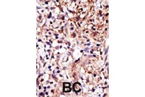 Formalin-fixed and paraffin-embedded human cancer tissue reacted with the primary antibody, which was peroxidase-conjugated to the secondary antibody, followed by DAB staining. (Caprin-1 antibody  (C-Term))