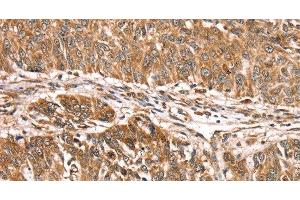 Immunohistochemistry of paraffin-embedded Human lung cancer using PDLIM4 Polyclonal Antibody at dilution of 1:30