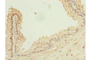 Immunohistochemistry of paraffin-embedded human prostate cancer using ABIN7163733 at dilution of 1:100 (POGZ antibody  (AA 1-300))