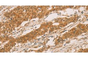Immunohistochemistry of paraffin-embedded Human gastric cancer tissue using SLC6A3 Polyclonal Antibody at dilution 1:50 (SLC6A3 antibody)