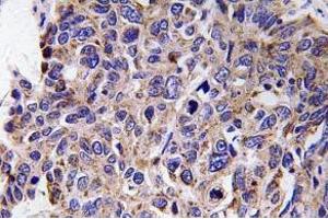 Immunohistochemistry (IHC) analyzes of MMP-12 antibody in paraffin-embedded human lung carcinoma tissue. (MMP12 antibody)