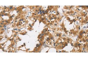 Immunohistochemistry of paraffin-embedded Human thyroid cancer tissue using DUSP23 Polyclonal Antibody at dilution 1:30 (DUSP23 antibody)