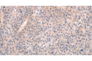 Immunohistochemistry of paraffin-embedded Human liver cancer tissue using ABCF1 Polyclonal Antibody at dilution 1:40 (ABCF1 antibody)