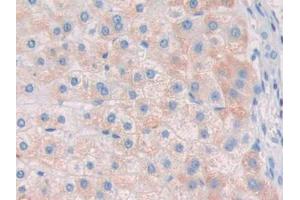 IHC-P analysis of Human Liver cancer Tissue, with DAB staining. (Ribonuclease A8 antibody  (AA 19-154))