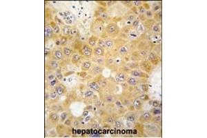 Formalin-fixed and paraffin-embedded human hepatocarcinoma tissue reacted with H1 antibody (N-term) 6302a , which was peroxidase-conjugated to the secondary antibody, followed by DAB staining. (APH1A antibody  (N-Term))