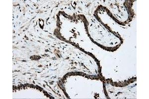 Immunohistochemical staining of paraffin-embedded Carcinoma of prostate tissue using anti-PRKAR2A mouse monoclonal antibody. (PRKAR2A antibody)