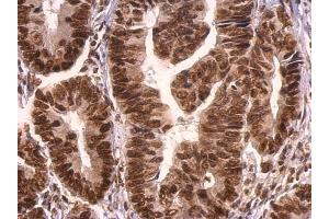 IHC-P Image GRB2 antibody detects GRB2 protein at nucleus on human colon carcinoma by immunohistochemical analysis.